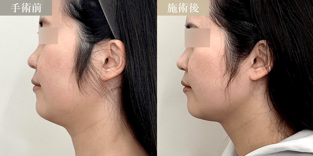 脂肪吸引＋糸リフト