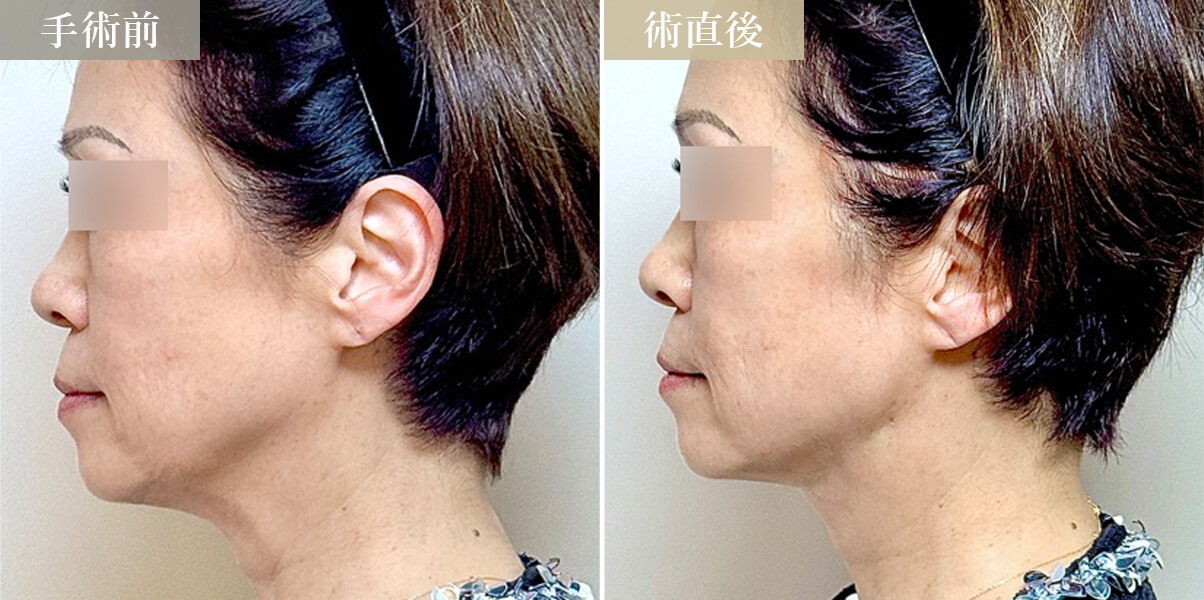 顎下＋フェイスラインの糸リフト