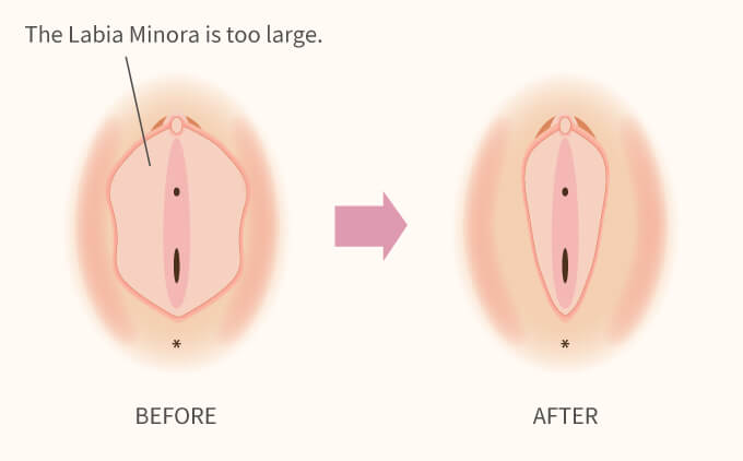 What is labiaplasty?