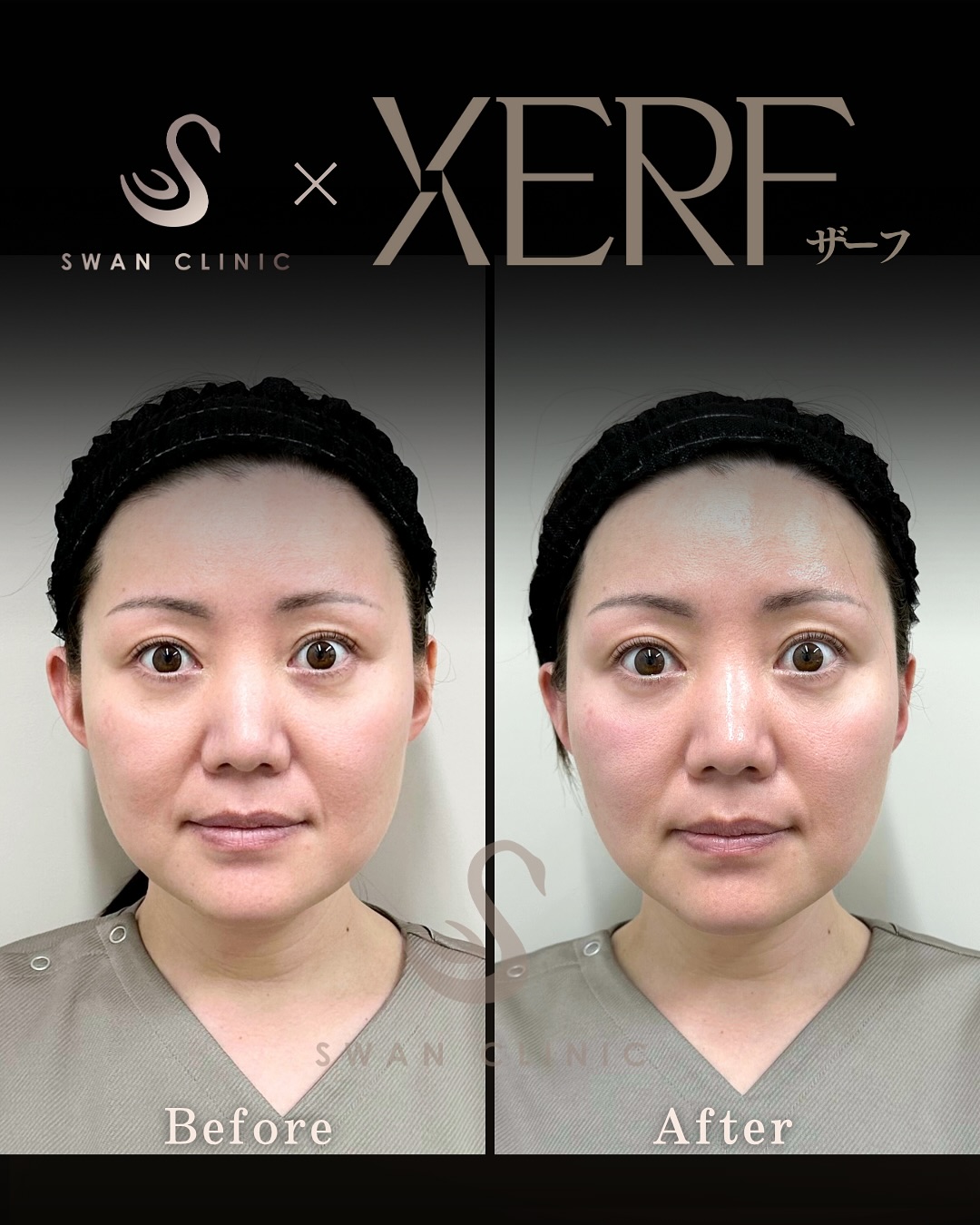 痛くないたるみ治療XERF