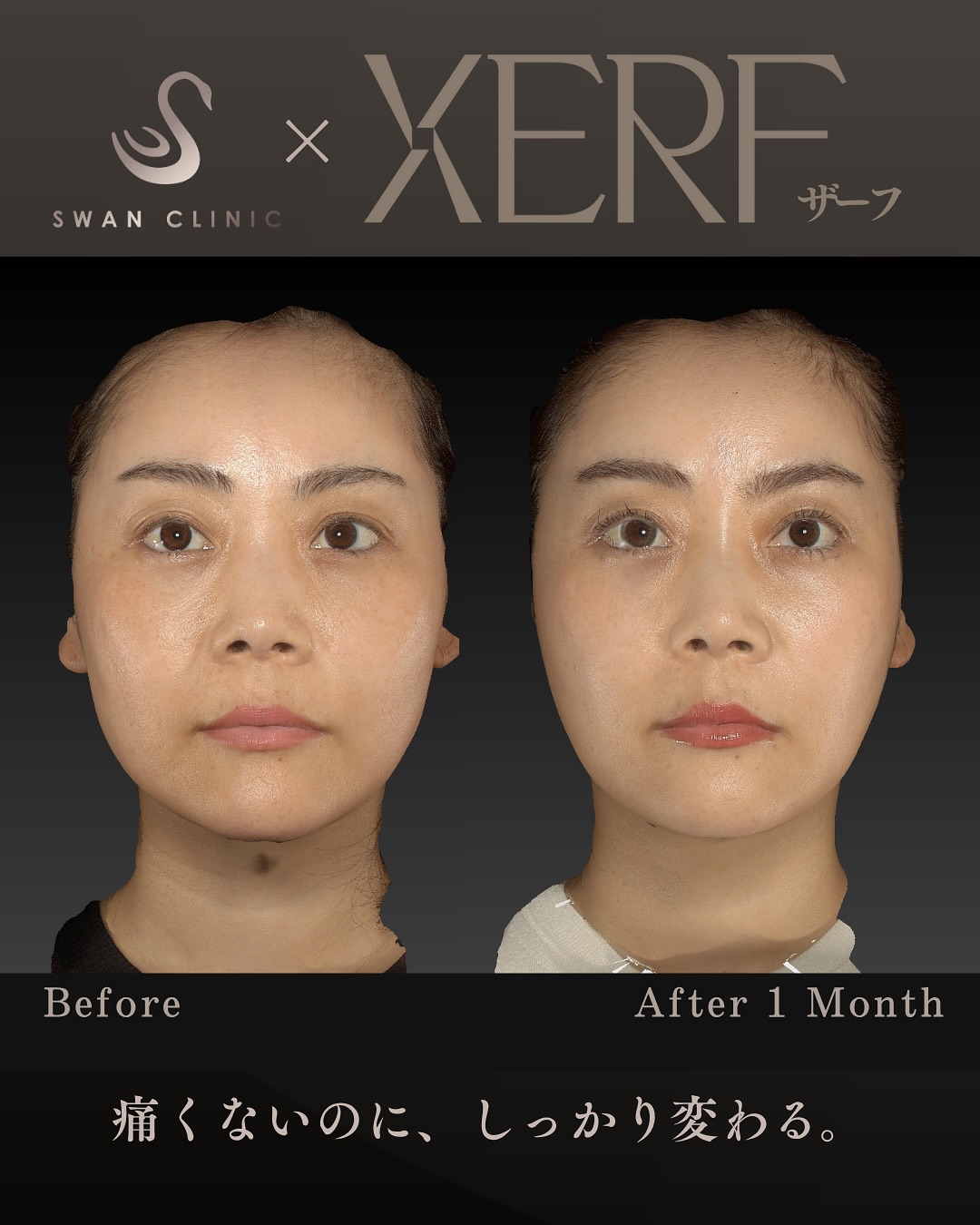 痛みを感じず確かな変化を感じられるXERF