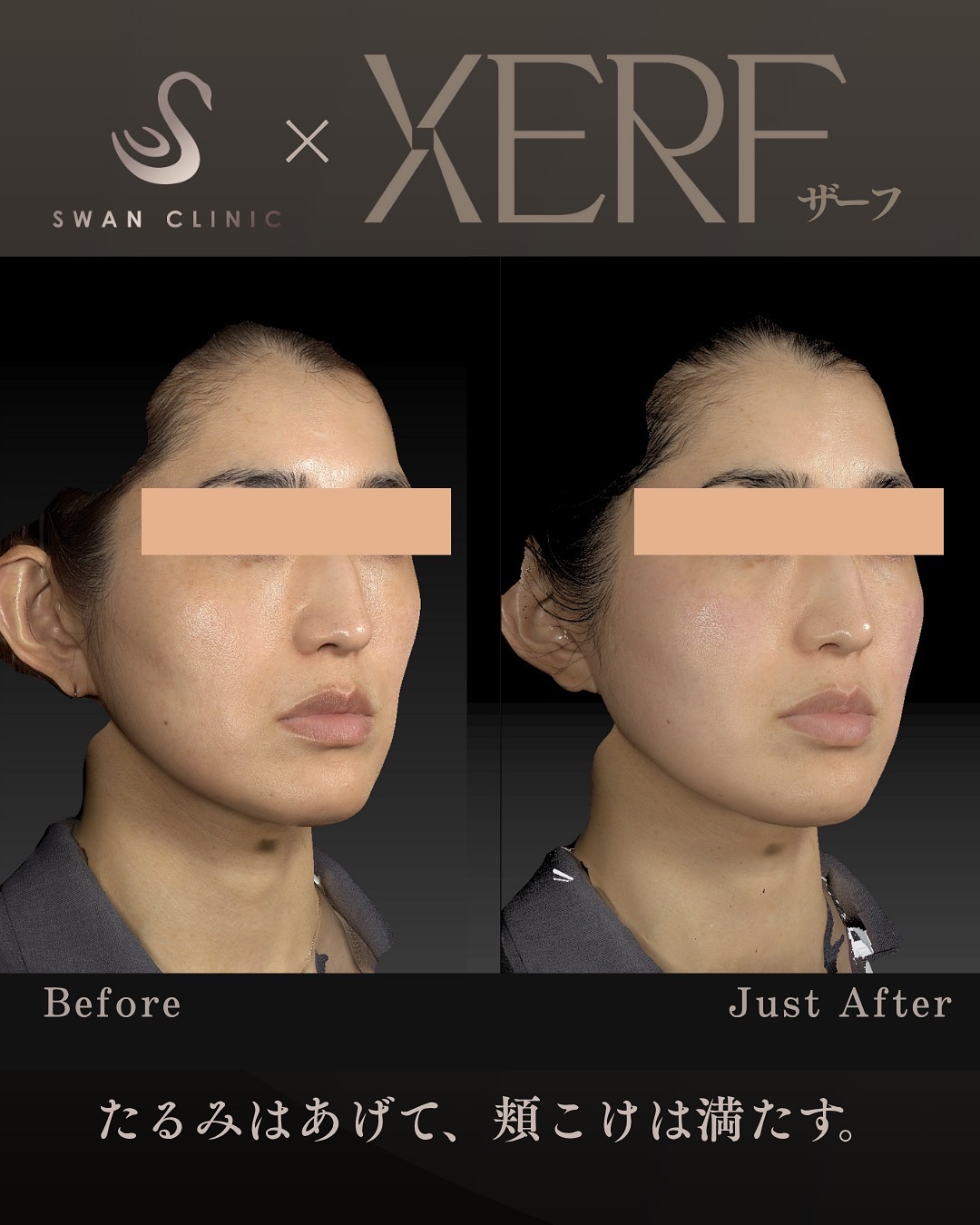 最新式のたるみ治療「XERF」