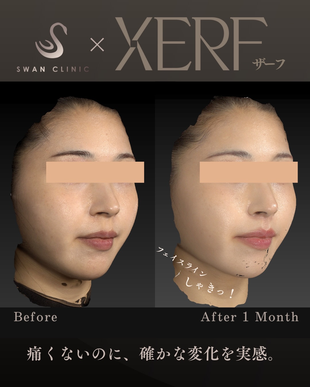 痛みを感じず確かな変化を感じられるXERF