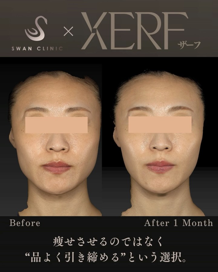 最新式のたるみ治療「XERF」