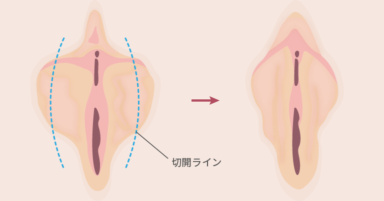 小陰唇縮小術