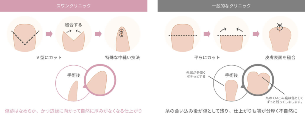 小陰唇縮小術