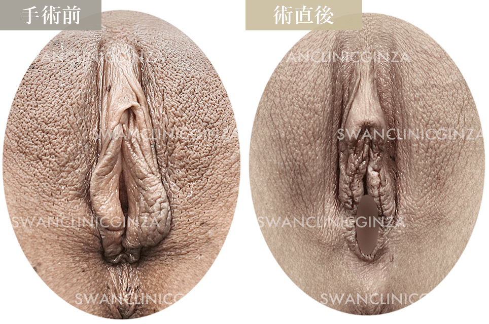 小陰唇縮小術