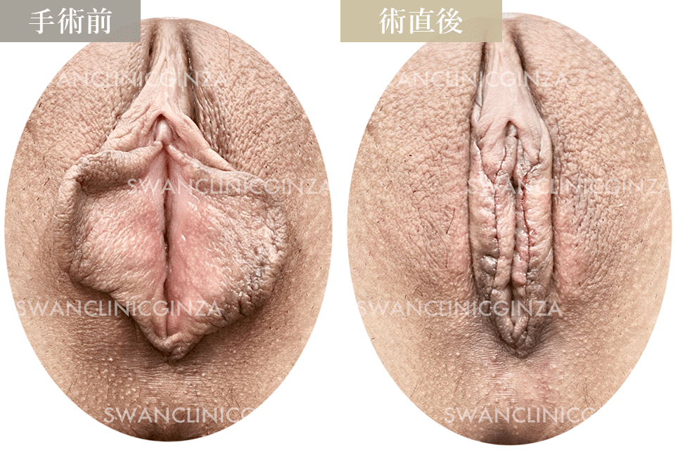 小陰唇縮小術＋副皮切除