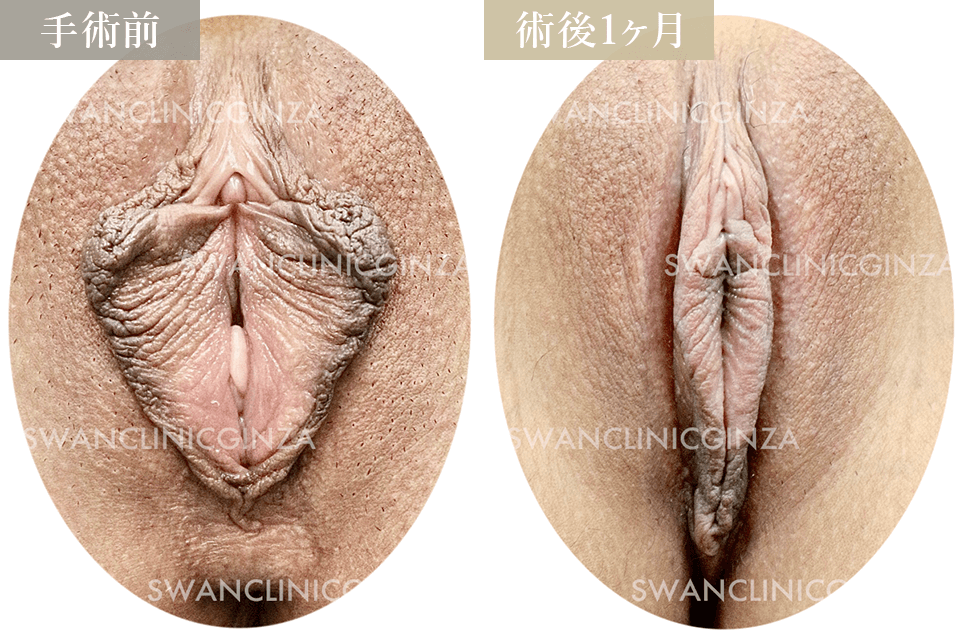 小陰唇縮小術＋副皮切除