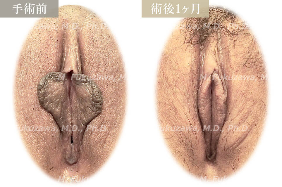 小陰唇縮小術