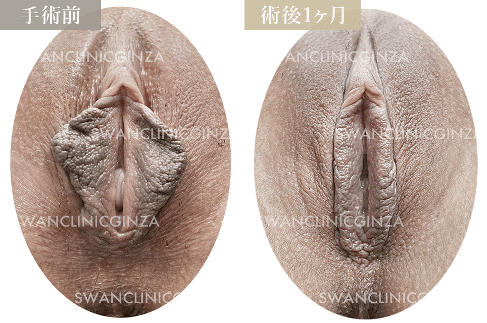 小陰唇縮小術＋右側副皮切除