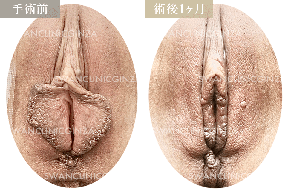 小陰唇縮小術＋副皮切除