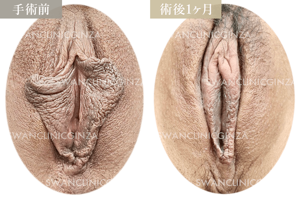 小陰唇縮小術＋副皮切除