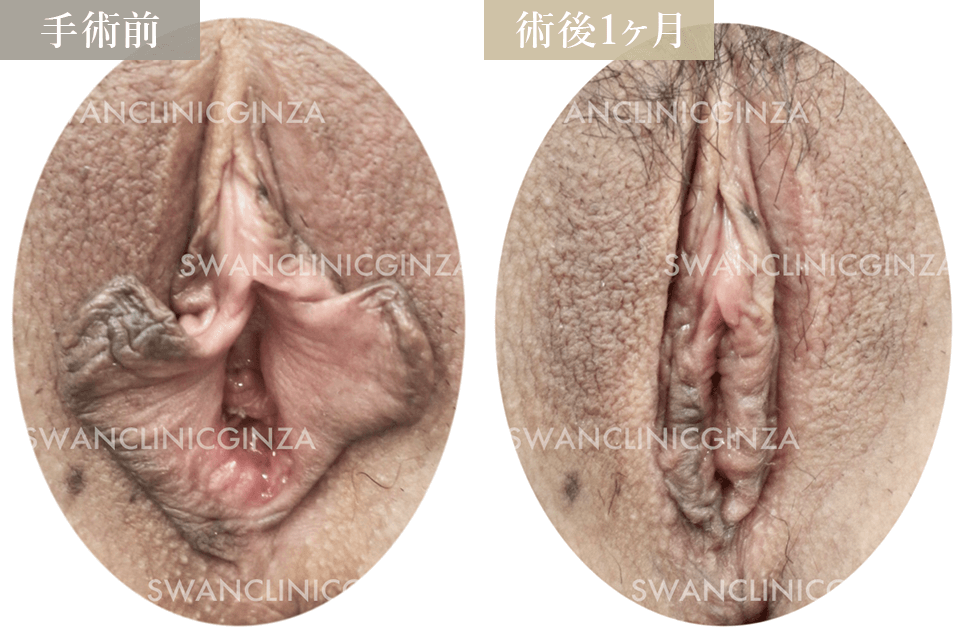 小陰唇縮小術＋副皮切除