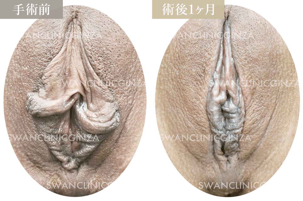 小陰唇縮小術＋副皮切除