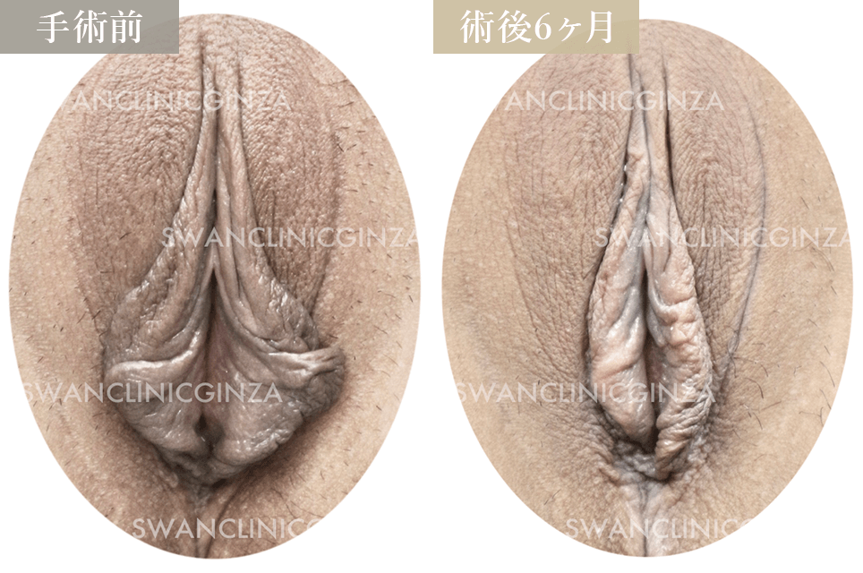 小陰唇縮小術＋副皮切除