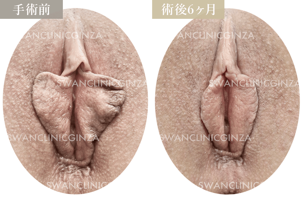 小陰唇縮小術
