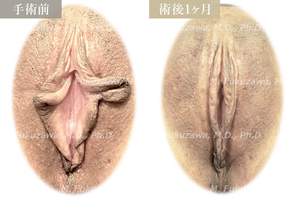 小陰唇縮小術
