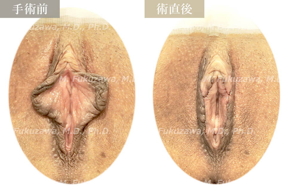 小陰唇縮小術