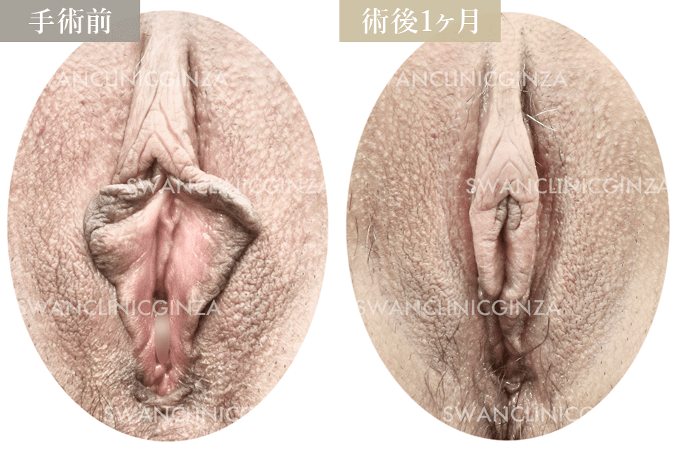 小陰唇縮小術＋陰核包茎