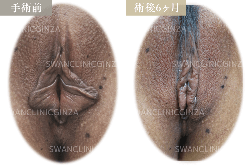小陰唇切除術＋左副皮切除
