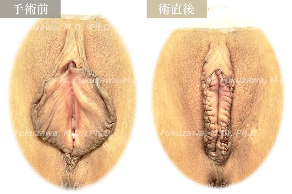 小陰唇縮小術