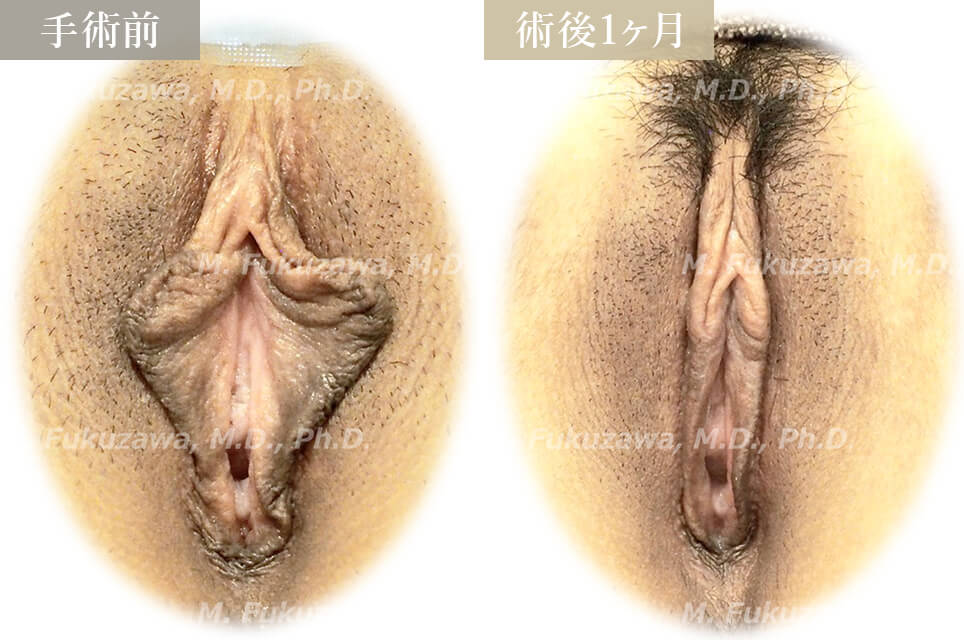 小陰唇縮小術