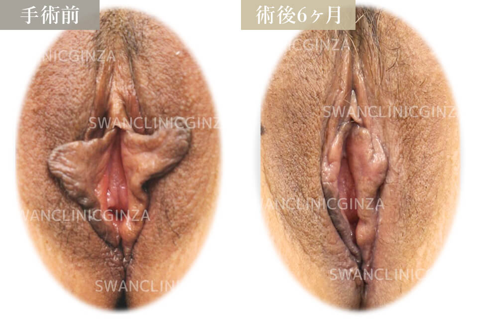 小陰唇縮小術＋副皮切除