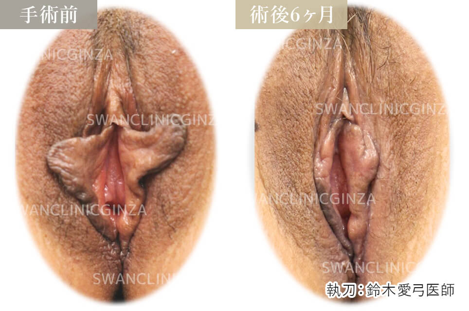 小陰唇縮小術＋副皮切除