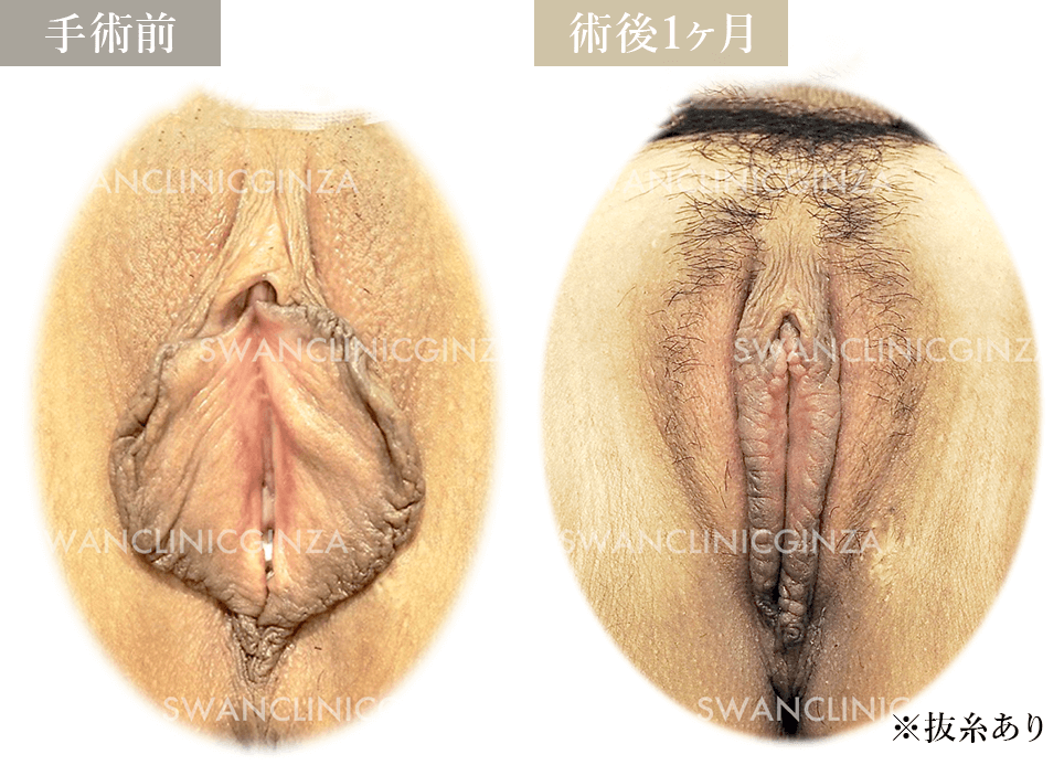 小陰唇縮小術