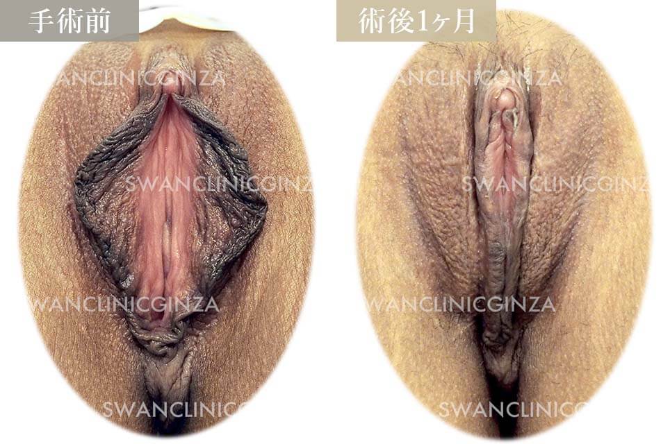 小陰唇縮小術