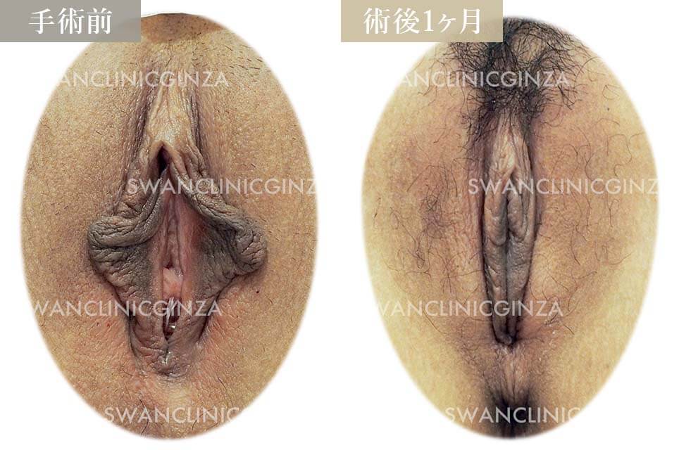 小陰唇縮小術