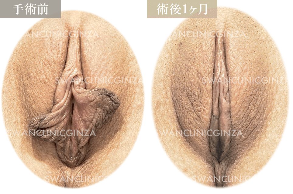 小陰唇縮小術