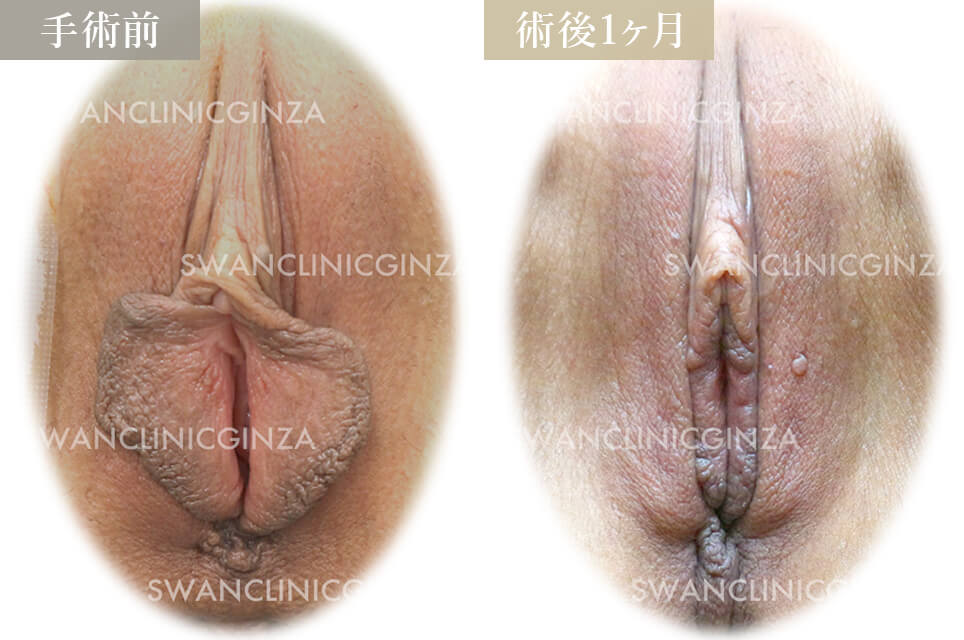 小陰唇縮小術