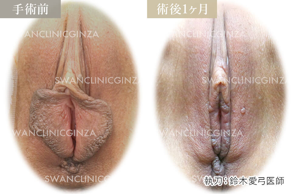 小陰唇縮小術