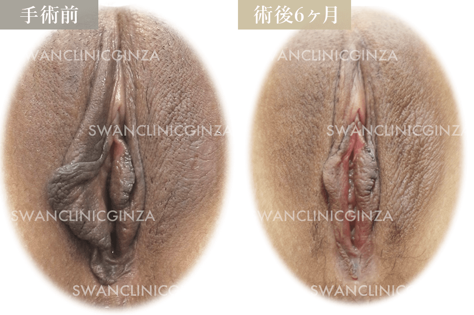 小陰唇縮小術