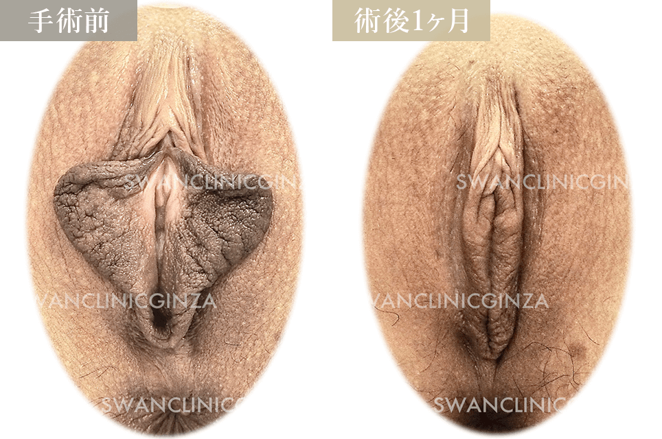 小陰唇縮小術