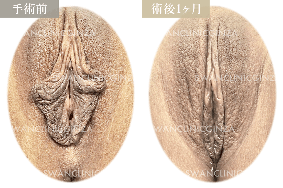 小陰唇縮小術