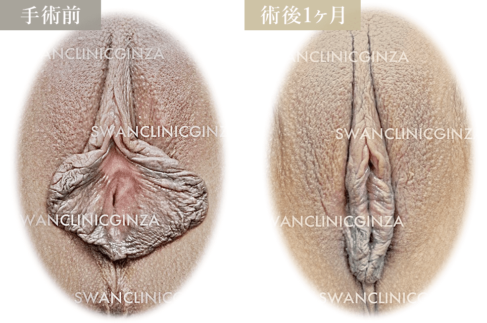 小陰唇縮小術