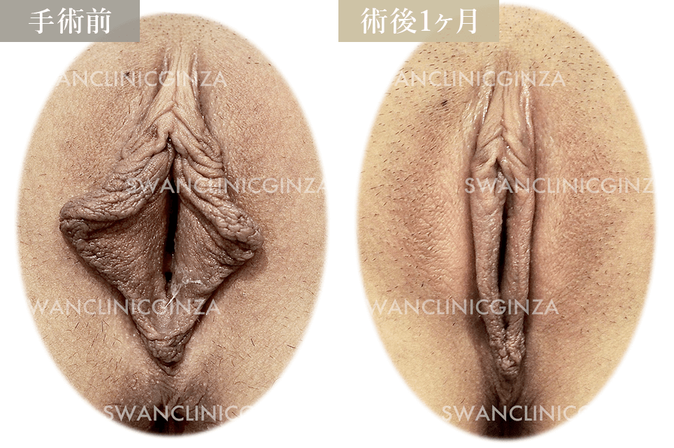 小陰唇縮小術