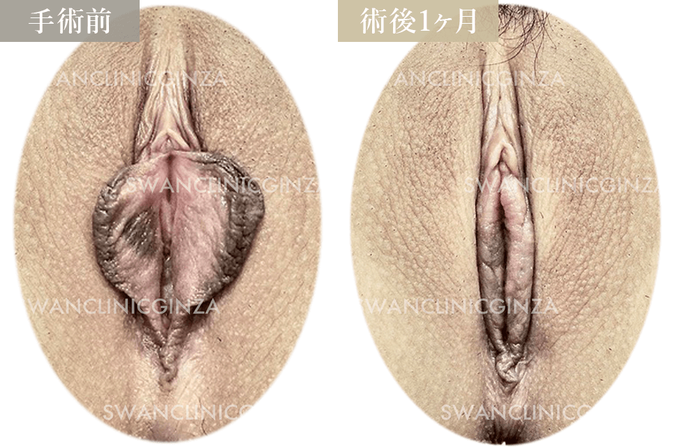 小陰唇縮小術