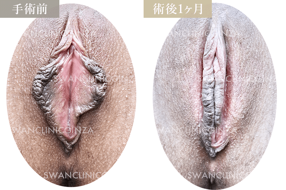 小陰唇縮小術