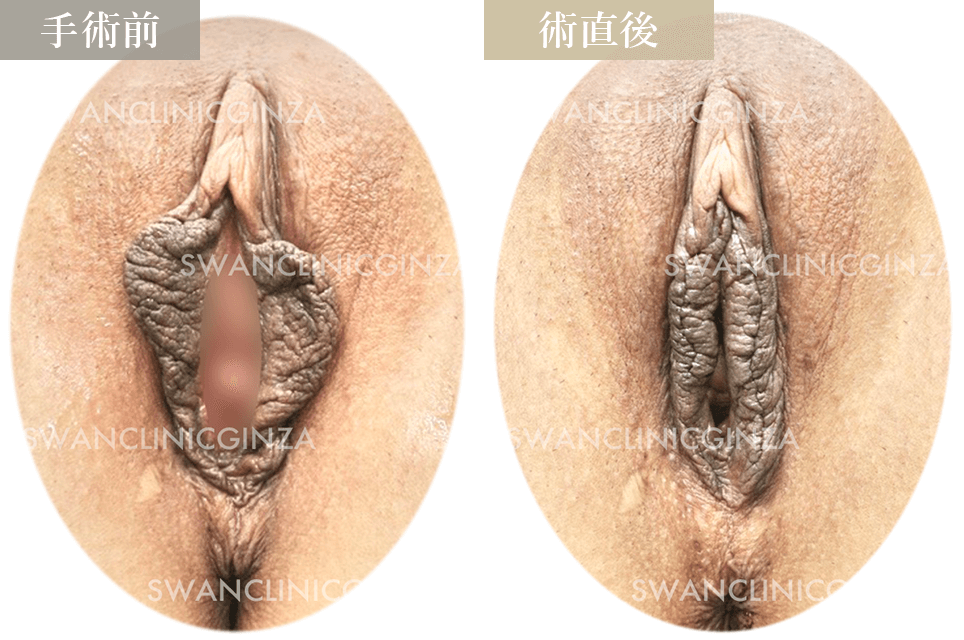 小陰唇縮小術