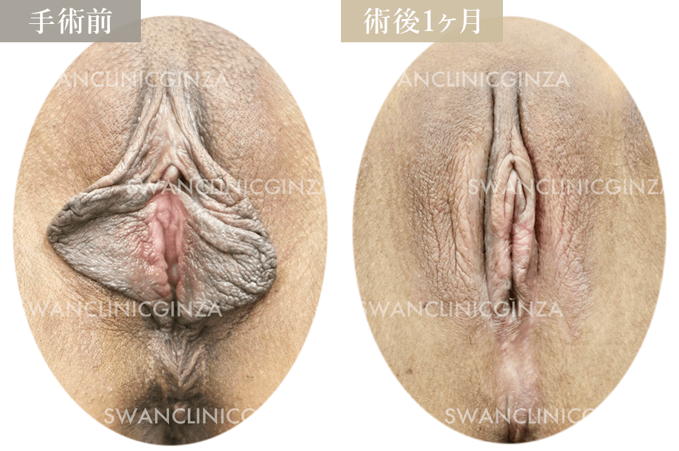 小陰唇縮小術＋副皮切除