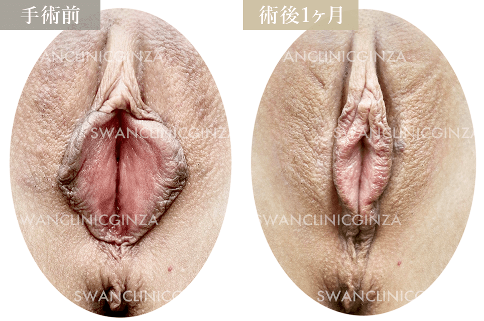 小陰唇縮小術＋右副皮切除