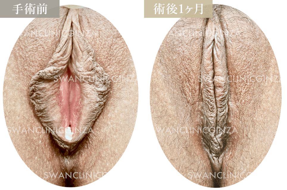 小陰唇縮小術＋副皮切除