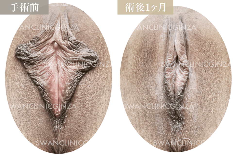 小陰唇縮小術＋副皮切除