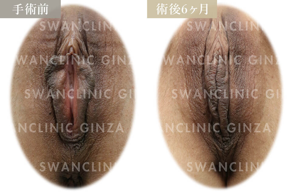 小陰唇縮小術＋副皮切除