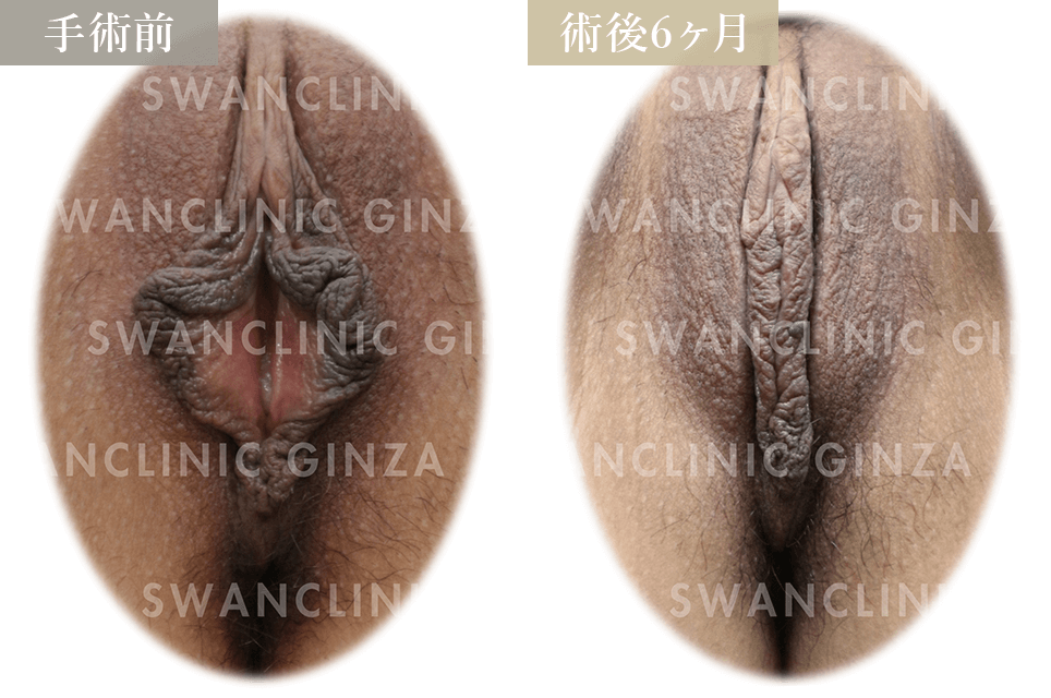小陰唇縮小術＋副皮切除
