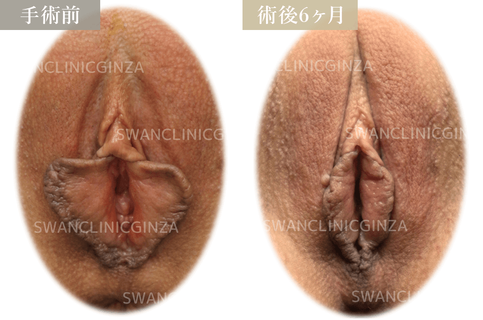 小陰唇切除術＋陰核包皮切除